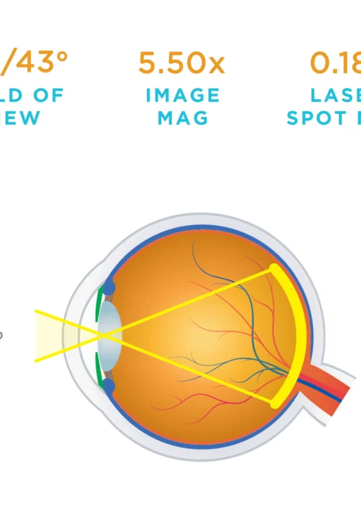 Lente Volk® Macula plus 5.5