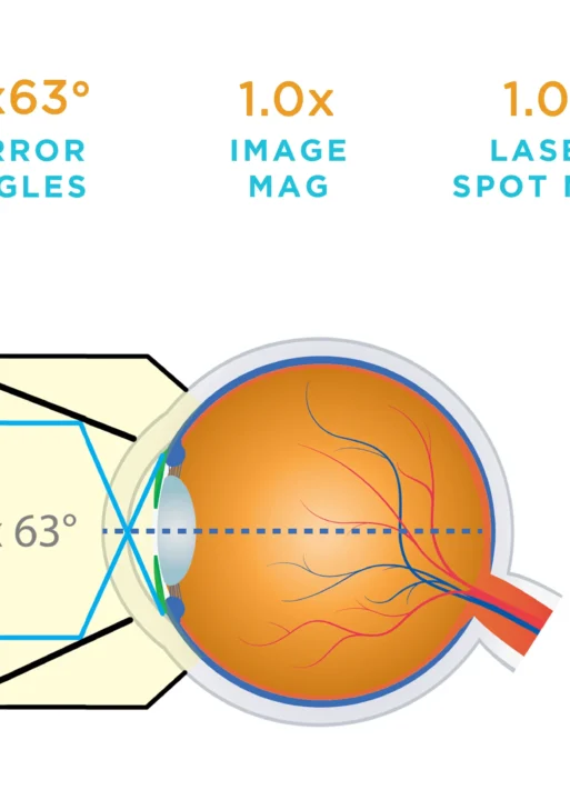 Lente Volk® Gonio monouso 4 specchi (1 confezione da 10)