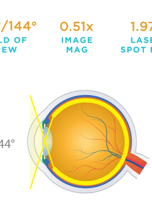 Lente Volk® QuadrAspheric®
