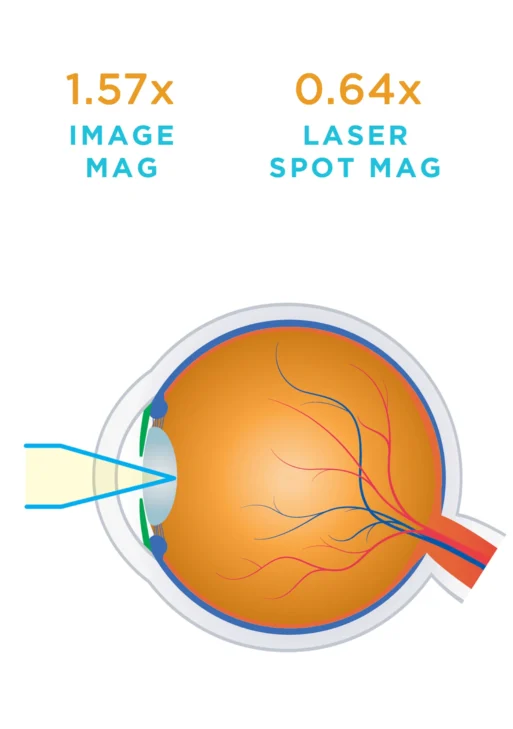 Lente Volk® Capsulotomia