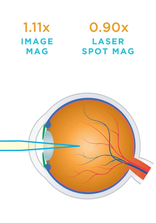 Lente Volk® Idrees Mid-Vitreous