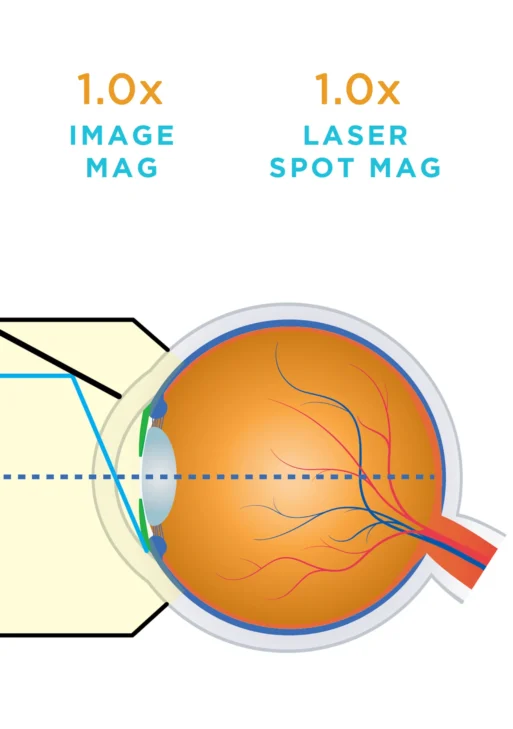 Lente Volk® per Trabeculoplastica Laser Selettiva (SLT)