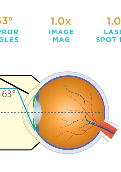 Lente Volk® 1 Monouso SLT (1 confezione da 10)