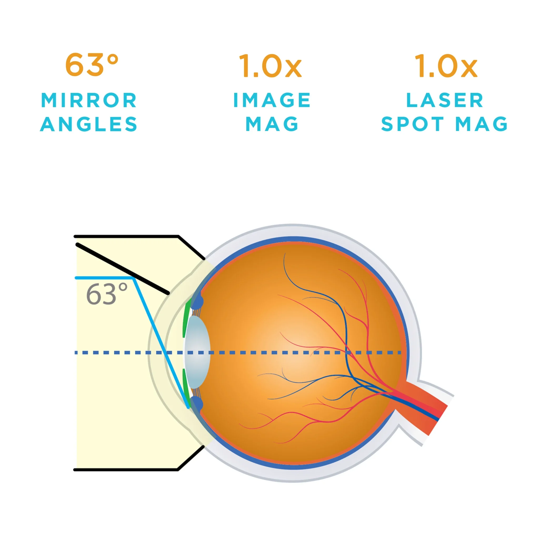 Lente Volk® 1 Monouso SLT (1 confezione da 10) - immagine 1
